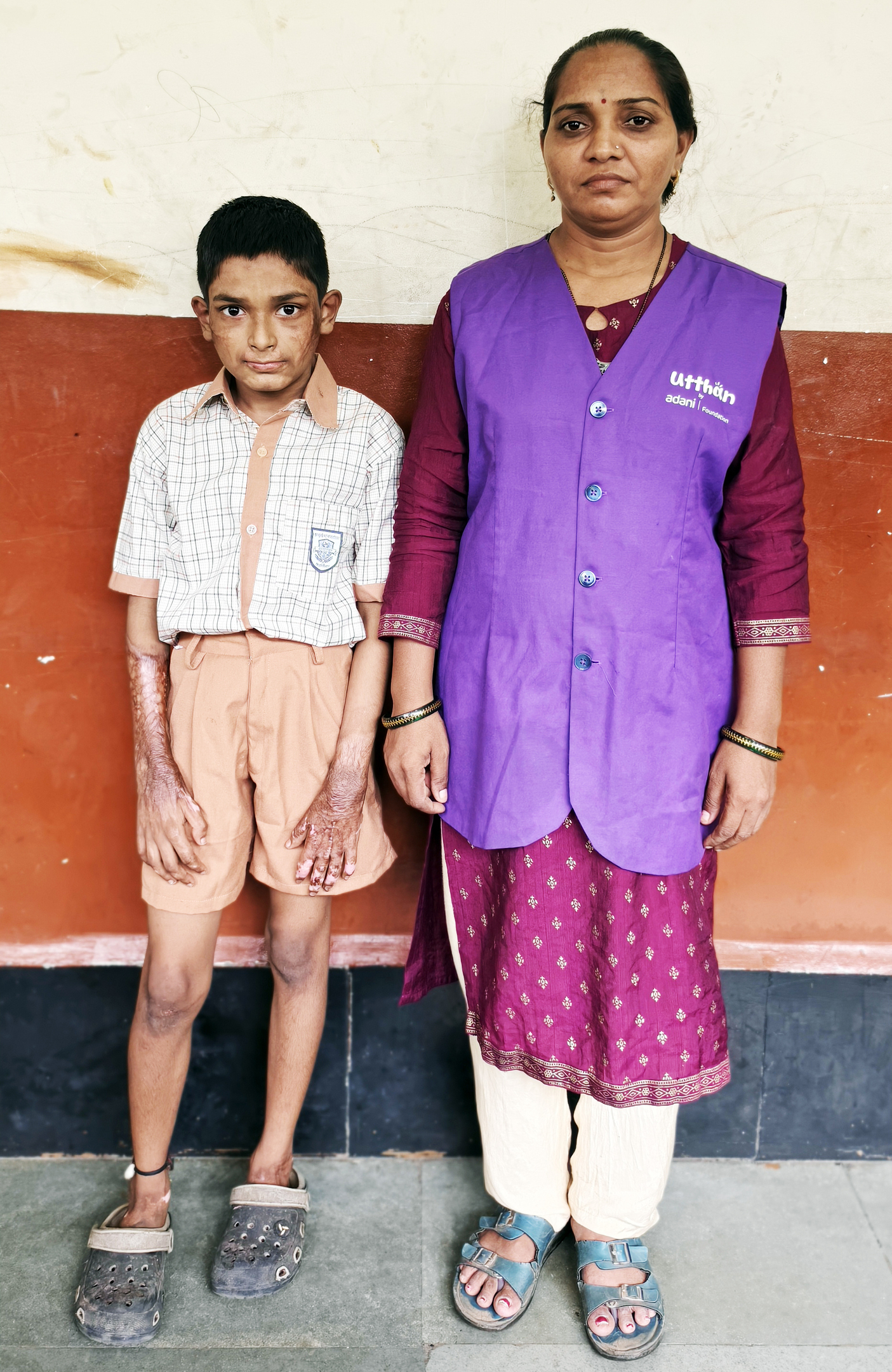 A boy with skin scars and a woman in a purple vest with the "uttthan adani foundation" logo.